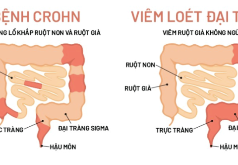 Phân biệt IBS với viêm đại tràng hoặc bệnh Crohn